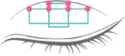 6点固定のシェーマ